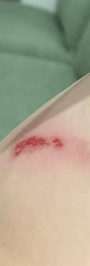 Before — Skin Shield